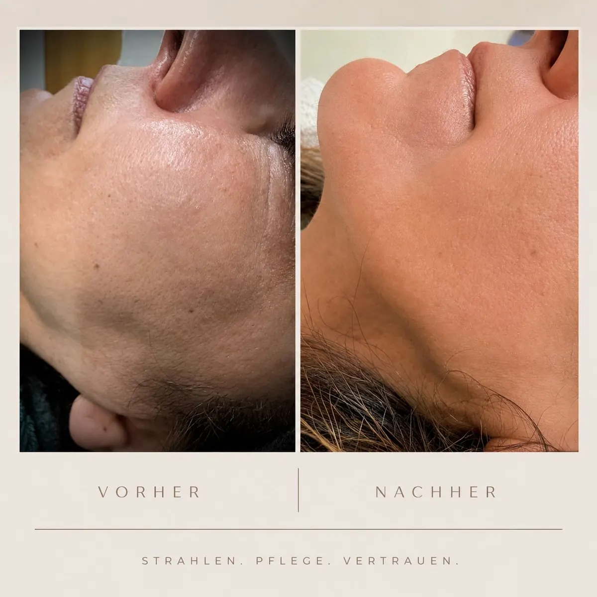 Aquaneedling vorher / nachher
